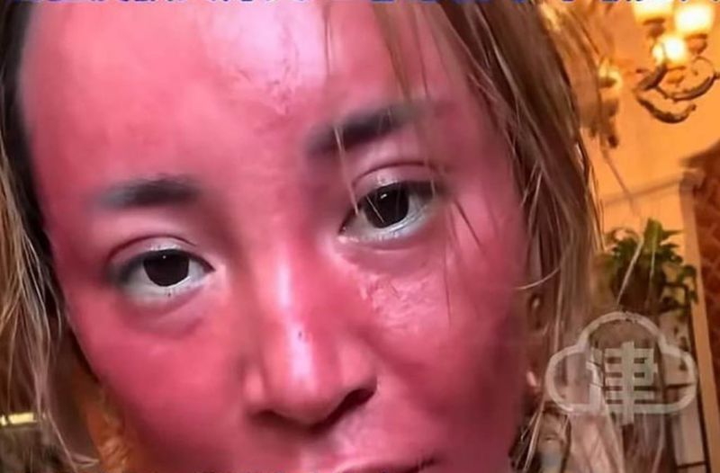Wajah wanita ini iritasi parah karena tidak pernah hapus makeup selama 22 tahun.