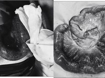 Merinding, Pasien Alami Komplikasi Pasca Operasi, Ususnya Tiba-tiba Keluar