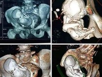 Heboh Bayi Membatu di Perut Wanita 73 Tahun, Ketahuan gegara Nyeri