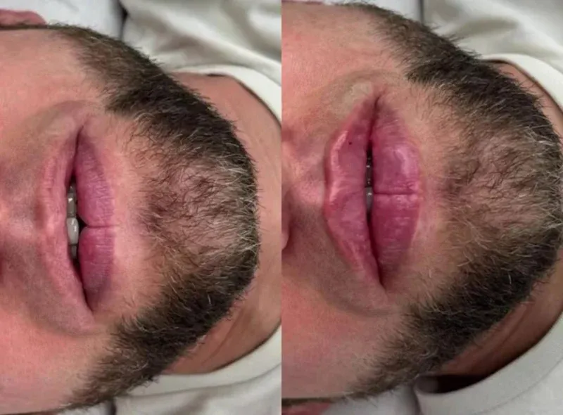 Tren Pria Filler Bibir
