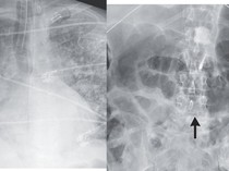 Penampakan Cacing Parasit di Tubuh Pasien Pasca Terima Donor Ginjal