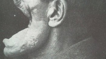 Cedera Wajah yang Mengerikan (dan Hampir Mematikan) yang Diderita Prajurit Jerman dalam Perang Dunia I (1914-1918) Foto: Boredpanda