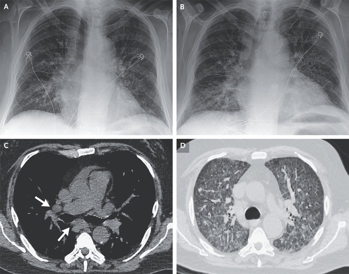 Sebuah laporan mempublikasikan 2 pasien yang tubuhnya dipenuhi cacing parasit. Ini terjadi usai menerima donor ginjal dari Karibia.