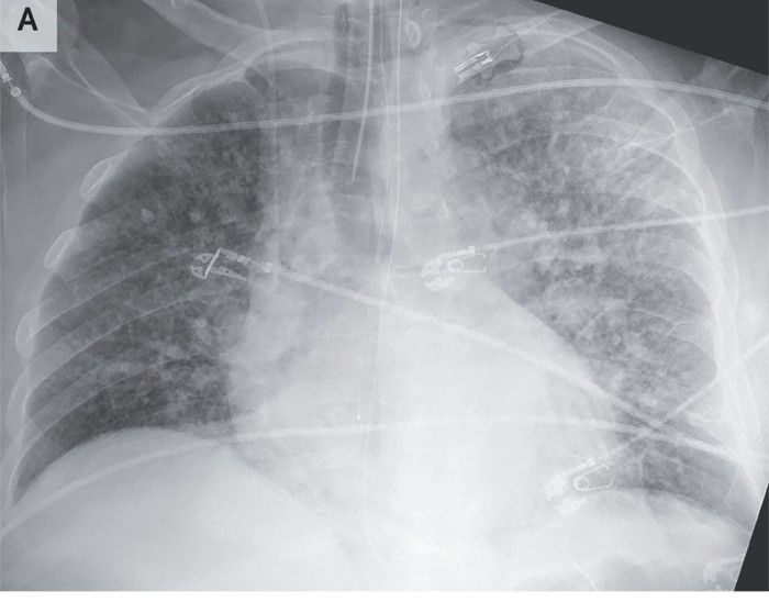 Sebuah laporan mempublikasikan 2 pasien yang tubuhnya dipenuhi cacing parasit. Ini terjadi usai menerima donor ginjal dari Karibia.