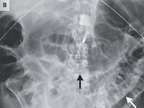 Tubuh Mungil Raya yang Dipenuhi Cacing, Ini Kata Pakar Kesehatan Unpad