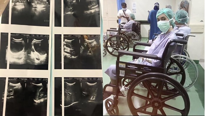 Cerita Wanita di Jaktim Kena Kanker Usus di Usia 20, Keluhkan Nyeri Perut Seperti Ini