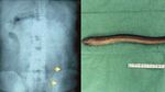 Momen Dokter Keluarkan Belut Hidup di Tubuh Pasien, Ada yang Panjangnya 65 Cm!