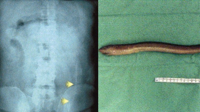 Belut di tubuh pasien