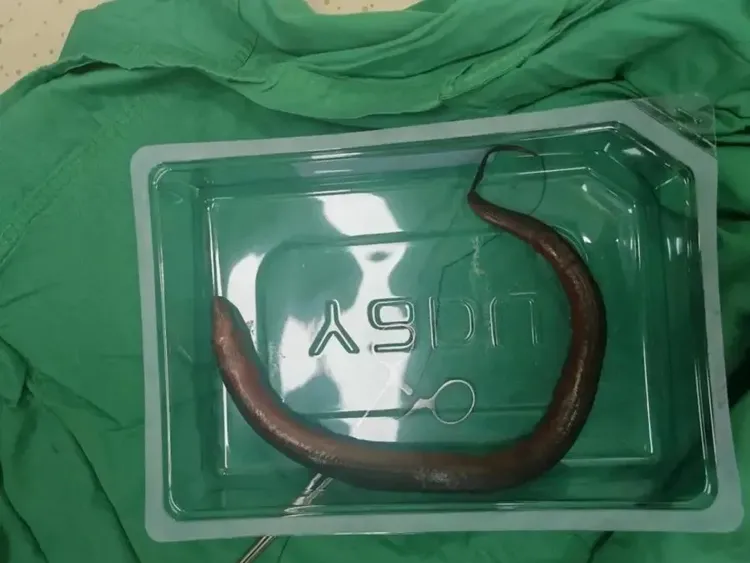 Momen Dokter Keluarkan Belut Hidup di Tubuh Pasien, Ada yang Panjangnya 65 Cm!