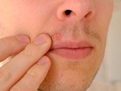 Jerawat di Bawah Hidung Tanda Lagi Jatuh Cinta? Ini Mitos dan Faktanya