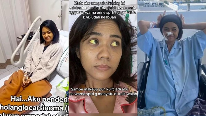 Wanita pengidap kanker saluran empedu stadium 4