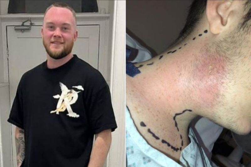 Geraint Mullins, alami abses hingga dirawat di ICU gara-gara memencet jerawat di leher.