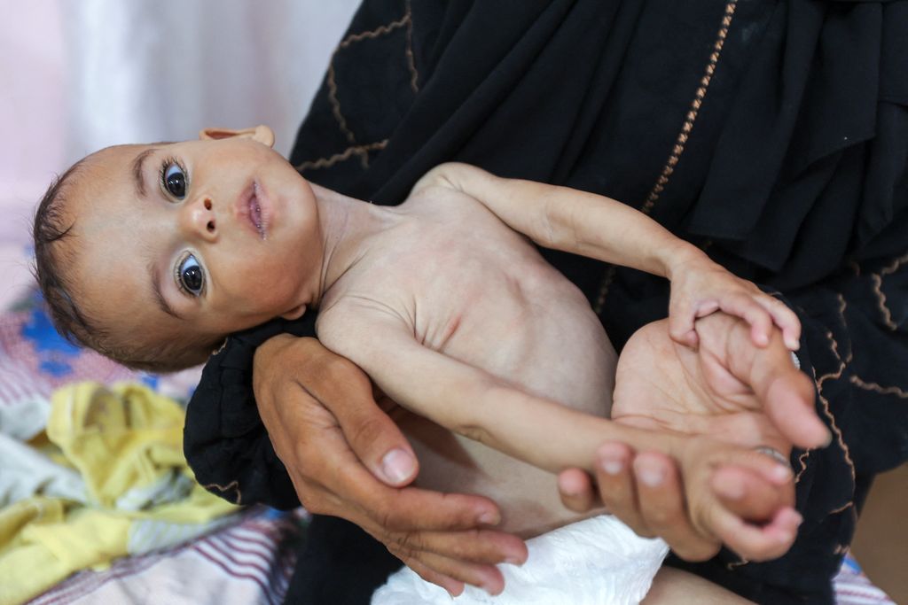 Seela Barbakh, an 11-month-old Palestinian girl who is malnourished, according to medics, is held by her mother, Najah, at Nasser Hospital in Khan Younis, in the southern Gaza Strip, July 23, 2025. REUTERS/Ramadan Abed