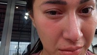 Dita Fakhrana memperlihatkan matanya yang bonyok gegara bola padel. (Foto: dok Instagram fakhranaaa)