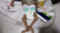 Tubuh bayi Palestina, Zainab Abu Haleeb, yang berusia lima bulan meninggal akibat malnutrisi, berada di Nasser Hospital, Khan Younis, Gaza Selatan, Sabtu (26/7/2025). Berat badannya lebih rendah daripada saat lahir — kurang dari 2 kg, padahal saat lahir beratnya sekitar 3 kg. (REUTERS/Ramadan Abed)  