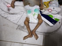 Potret Pilu Bayi di Gaza Meninggal karena Malnutrisi