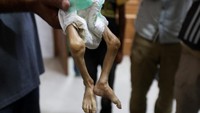 Kasus ini termasuk dalam total 127 kematian akibat malnutrisi yang dilaporkan sejak awal konflik—termasuk 85 anak-anak—menurut Kementerian Kesehatan Gaza. Organisasi internasional juga mencatat lonjakan kasus malnutrisi akut di berbagai rumah sakit Gaza. (REUTERS/Ramadan Abed)  
