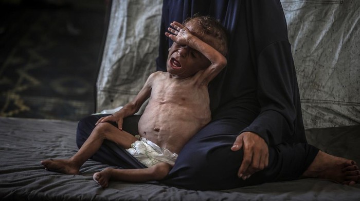 GAZA CITY, GAZA - JULY 24: One-and-a-half-year-old Muhammed Zakariya Ayyub al-Matouk, one of thousands of children suffering from hunger and malnutrition in Gaza, faces life-threatening conditions due to Israels ongoing attacks and blockade in Gaza City, Gaza on July 24, 2025. Severely weakened, Matouk struggles to survive in a tent in Gaza City, where there is no access to milk, food, or basic necessities. (Photo by Ali Jadallah/Anadolu via Getty Images)
