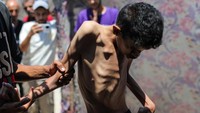 Hamza Mishmish, 25 tahun, mengalami malnutrisi parah dan pengeroposan tulang di Kamp Pengungsi Nuseirat, Deir al-Balah, Gaza, Sabtu (27/7/2025). Krisis pangan di Gaza makin memburuk dan berdampak pada seluruh kelompok usia. (Hassan Jedi/Anadolu via Getty Images)  