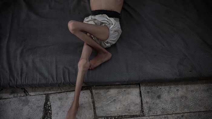 Malnutrisi Ancam Nyawa Anak-Anak di Gaza  Six-year-old Malik Nidal Saad suffers from severe malnutrition in a tent in western Gaza, where he took shelter with his family after fleeing Beit Lahia, on July 27, 2025. Due to Israel's blockade on the Gaza Strip, Malik's weight dropped from 15 to 7 kilograms as a result of lack of food and supplements. His health continues to deteriorate, and his family is calling for urgent assistance to ensure access to proper treatment and nutrition. (Photo by Abdalhkem Abu Riash/Anadolu via Getty Images)