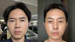 Perubahan Wajah Rafael Tan Sebelum dan Sesudah Operasi di Korea Selatan