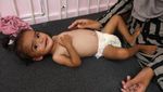 Tubuh Ringkih Bayi Gaza, Lengan Selebar Jari Orang Dewasa