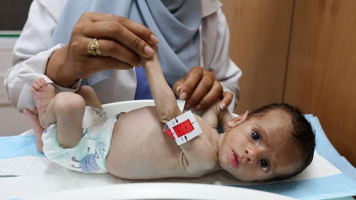 A nurse examines a malnourished child, according to medics, at Nasser Hospital in Khan Younis, southern Gaza Strip, July 25, 2025. REUTERS/Ramadan Abed