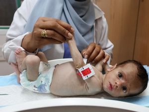 Mengenaskannya Bayi di Gaza Alami Malnutrisi, Lengan Hanya Sebesar Ibu Jari