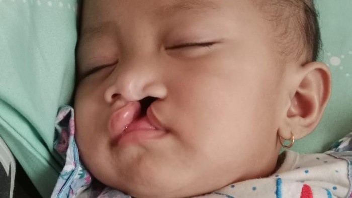 Balita Khalisa masih membutuhkan tiga tahapan operasi. (Dok. berbuatbaik.id)