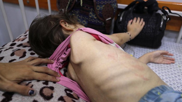 A Palestinian girl Jana Ayad, who is malnourished, according to medics, lies on a bed as her mother, Nasma Ayad, sits beside her, holding her hand, as she receives treatment at a hospital in Gaza City, amid a worsening hunger crisis, July 29, 2025. REUTERS/Mahmoud Issa