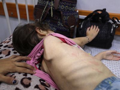 Potret Pilu Anak Palestina Bertahan dari Gizi Buruk di Tengah Perang