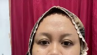 Bibirnya Bengkak Parah 3 Jam Sebelum Akad Nikah, Wanita Ini Viral di Medsos