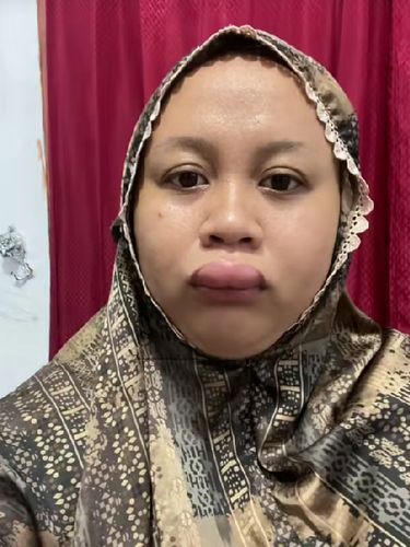 Pengantin wanita ini membagikan pengalaman yang tak terduga, bibirnya bengkak saat h-3 jam akad nikah.