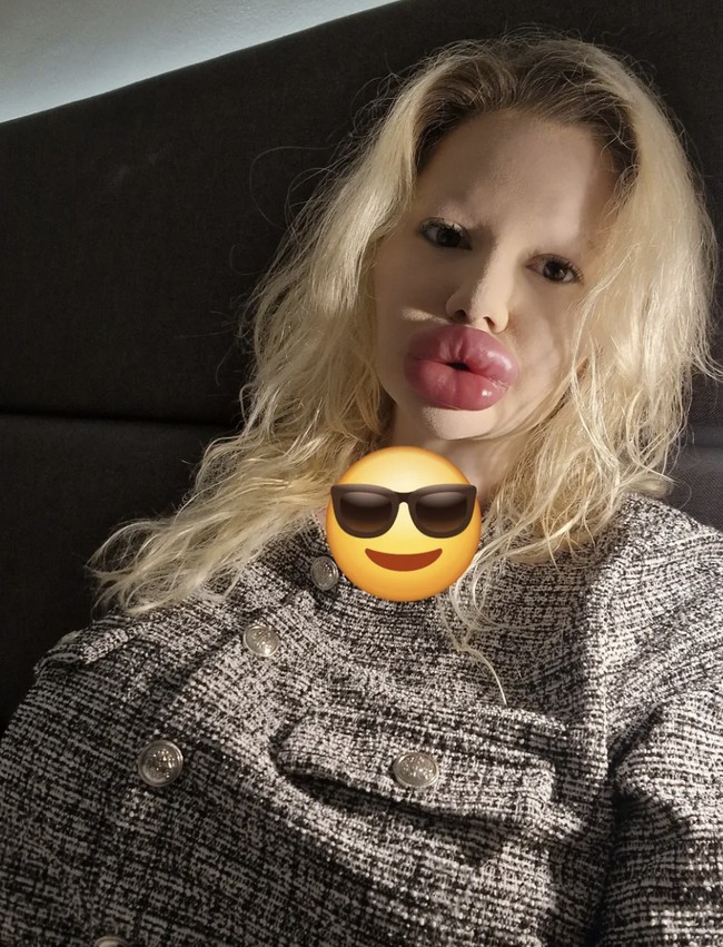 “Ada risiko seperti peradangan dan demam, terutama jika banyak suntikan dilakukan sekaligus. Tapi saya percaya pada dokter saya. Ia profesional yang sangat kompeten di bidang bedah estetika,” aku Andrea.  Foto: dok. Instagram @andrea88476