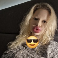 “Ada risiko seperti peradangan dan demam, terutama jika banyak suntikan dilakukan sekaligus. Tapi saya percaya pada dokter saya. Ia profesional yang sangat kompeten di bidang bedah estetika,” aku Andrea.  Foto: dok. Instagram @andrea88476