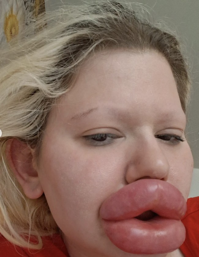 Andrea Ivanova jadi sorotan publik setelah mengunggah foto masa lalunya. Wanita ini bikin heboh dunia karena terobsesi dengan filler hingga dijuluki sebagai pemilik bibir terbesar.  Foto: dok. Instagram @andrea88476