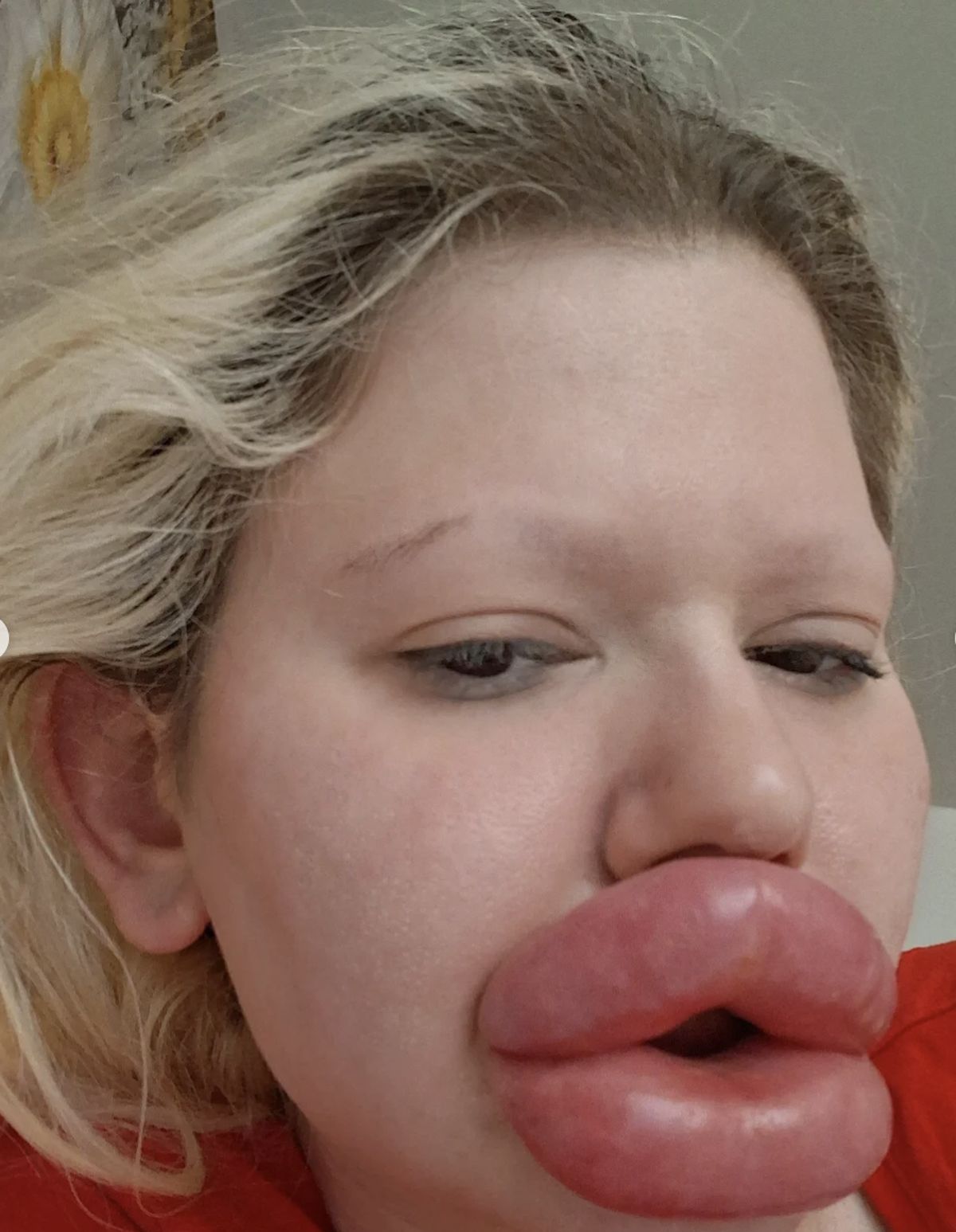 Mening qinimdan shish paydo boldi.