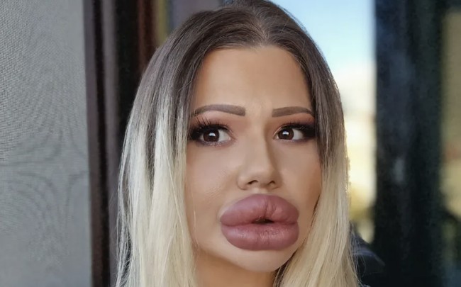 Namun di balik penampilannya yang mencolok, risiko kesehatan yang mengintai tidak bisa diabaikan. Bahkan dokter di Jerman mengungkapkan kekhawatiran terhadap dampak jangka panjang dari prosedur ekstrem yang dilakukan termasuk risiko nekrosis, yaitu kematian jaringan akibat kurangnya suplai darah. Foto: dok. Instagram @andrea88476