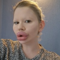 Sejak tahun 2018, Andrea telah menghabiskan sekitar 20 ribu poundsterling atau sekitar Rp 434 juta hanya untuk prosedur filler bibir. Namun obsesinya tak berhenti di sana. Ia juga menjalani serangkaian prosedur ekstrem lain seperti pembesaran dagu, kontur rahang, pembentukan tulang pipi, dan berbagai suntikan di wajah. Foto: dok. Instagram @andrea88476