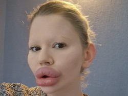 8 Transformasi Pemilik Bibir Terbesar di Dunia, Terancam Kematian Jaringan