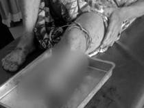 Detik-detik Bambang Diserang Buaya Saat Mancing Ikan hingga Kakinya Putus