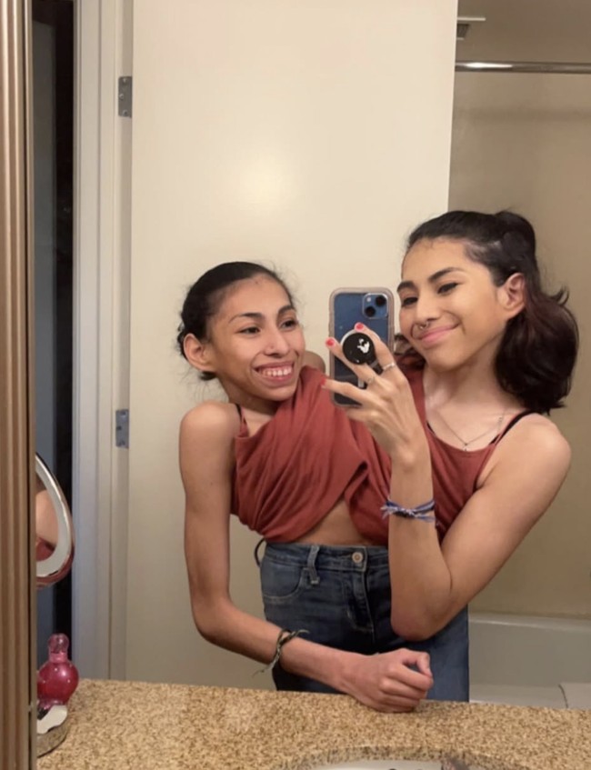 Carmen dan Lupita telah menjalani hidup bersama sejak lahir, termasuk menghadapi berbagai tantangan medis. Mereka belajar berjalan bersama setelah menjalani terapi fisik selama bertahun-tahun. Foto: dok. Instagram @it.be.dan @carmen_soland