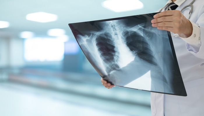 Doctor radiology looking chest or lung x-ray image to diagnose pneumonia or inflamed lungs. medical checkup concept.