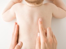 Video: Campak Lebih Menular dari Covid-19, IDAI Tekankan Pentingnya Imunisasi