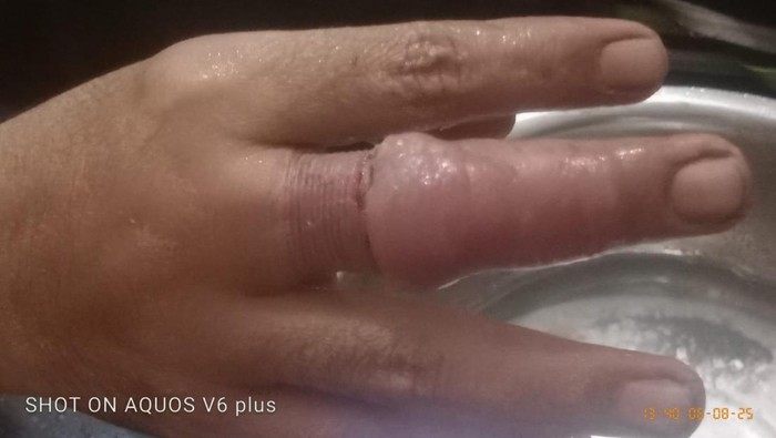 Proses pelepasan cincin mur yang nyangkut di jari