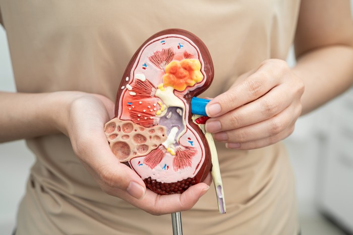 Chronic kidney disease, Asian woman with model for treatment urinary system, urology, Estimated glomerular filtration rate eGFR.