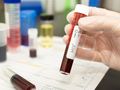 Perempuan di India Akhiri Hidup Usai Disuntik Darah Positif HIV oleh Mantan Kekasih