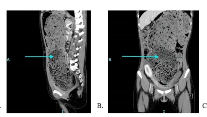 Kronologi Wanita 25 Tahun Perutnya Dipenuhi Tinja gegara Nggak BAB 4 Bulan