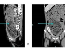 Perut Wanita 25 Tahun Penuh Tinja gegara Nggak Bisa BAB 4 Bulan