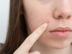 10 Makanan Penyebab Jerawat, Manis-manis hingga Gorengan Favorit